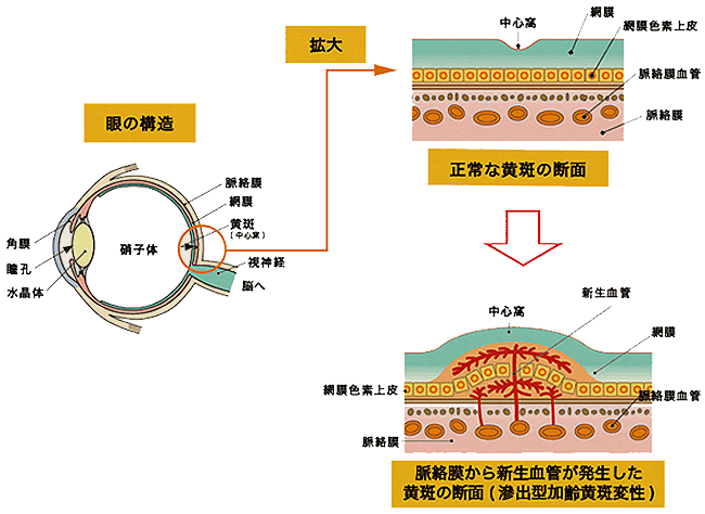 加齢黄斑変性